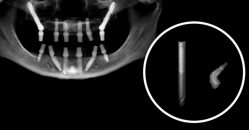 Zygomatic Dental Implants