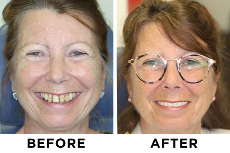 Our Dental Implant Patient Gallery | New Teeth Now Smiles