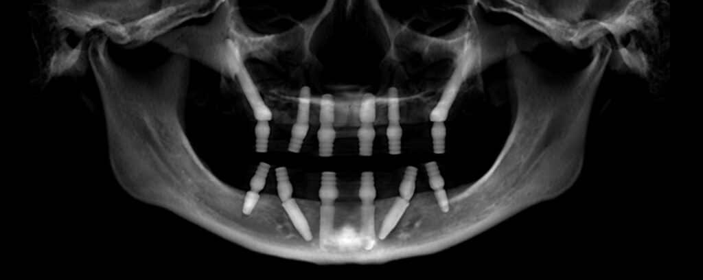 scan of zygomatic implants for patients with bone loss