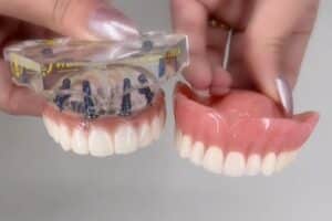 Dentures vs. dental implants