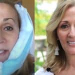 Recovering from Dental Implant Surgery: Tips and Advice from Those Who’ve Been There