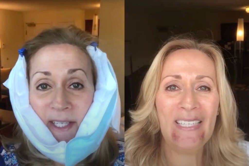 Our patient Karen documented her experience the first few days following surgery. she is wearing an ice pack.