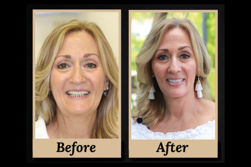 karen's before and after photo with New Teeth Now dental implant procedure.