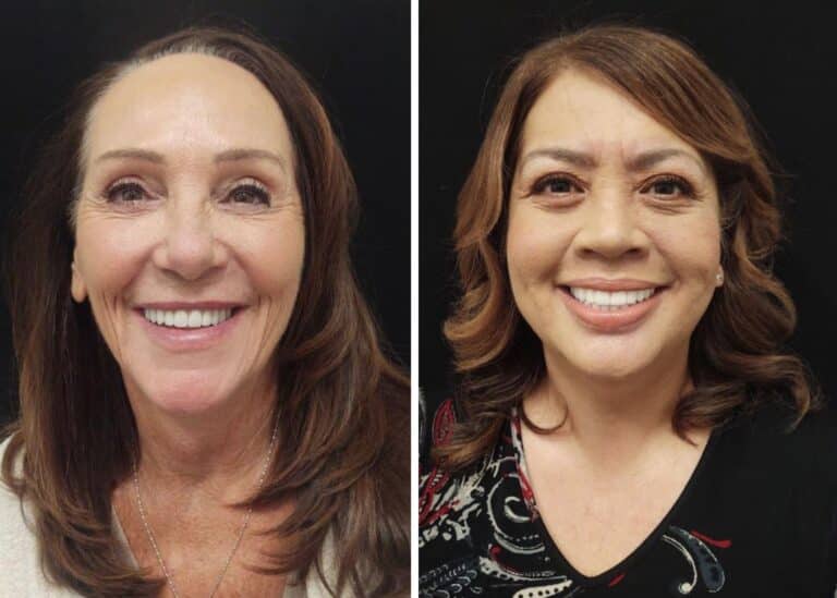 San Diego patients smiling in their beautiful full sets of dental implants.