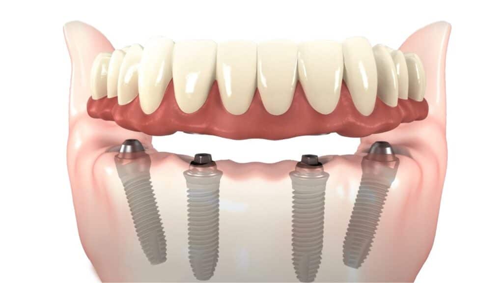 All-on-4 dental implant technique