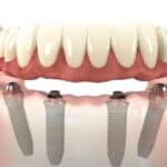 New Teeth Now – Dental Implants: Difference Between All-on-4 and All-on-X