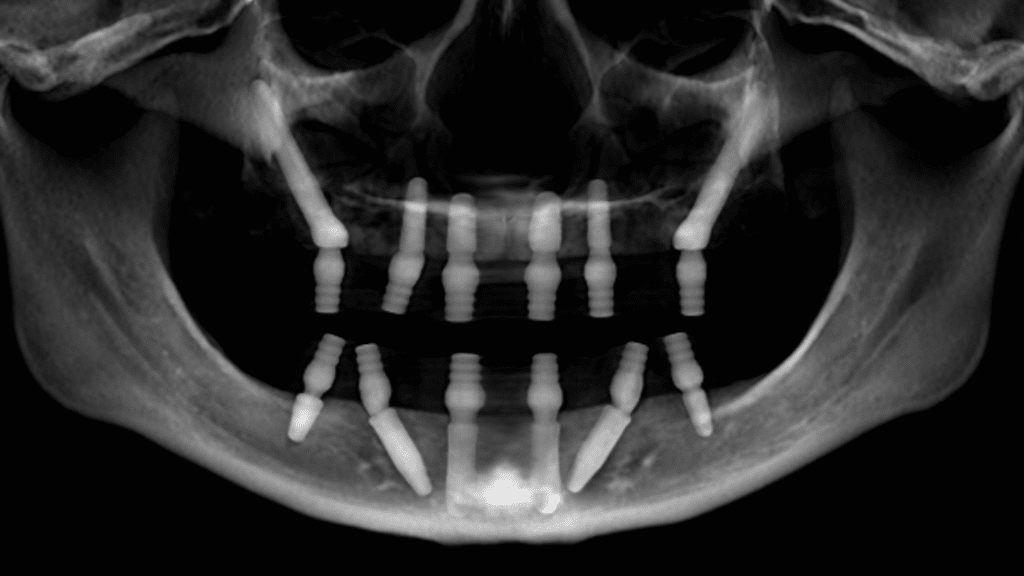 zygomatic implant scan new teeth now